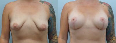 Breast Lift Before & After Gallery - Patient 146105319 - Image 1