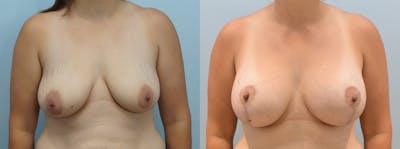 Breast Lift Before & After Gallery - Patient 146105323 - Image 1