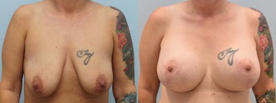 Breast Lift Before & After Gallery - Patient 146105354 - Image 1