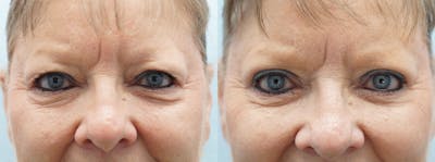 Eyelid Surgery Before & After Gallery - Patient 146105366 - Image 1