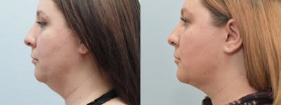 Facial Liposuction Before & After Gallery - Patient 146105370 - Image 1