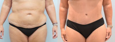 Tummy Tuck Before & After Gallery - Patient 146105498 - Image 1