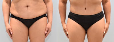 Tummy Tuck Before & After Gallery - Patient 146105529 - Image 1