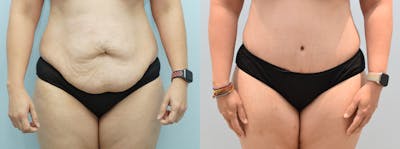 Tummy Tuck Before & After Gallery - Patient 146105603 - Image 1