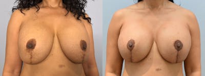 Breast Lift Before & After Gallery - Patient 146105610 - Image 1