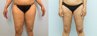 Thigh Lift Before & After Gallery - Patient 146105616 - Image 1