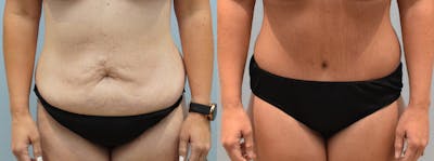 Body Lift Before & After Gallery - Patient 146105652 - Image 1