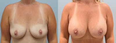 Breast Augmentation Before & After Gallery - Patient 146106021 - Image 1