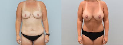 Mommy Makeover Before & After Gallery - Patient 146106039 - Image 1