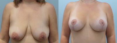 Breast Lift With Implants Before & After Gallery - Patient 146106068 - Image 1
