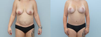 Mommy Makeover Before & After Gallery - Patient 146106073 - Image 1
