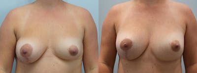 Breast Lift With Implants Before & After Gallery - Patient 146106349 - Image 1