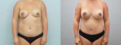 Mommy Makeover Before & After Gallery - Patient 146106350 - Image 1