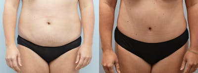 Tummy Tuck Before & After Gallery - Patient 146106373 - Image 1