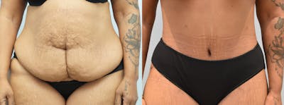 Body Lift Before & After Gallery - Patient 146106414 - Image 1