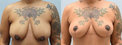 Breast Lift Before & After Gallery - Patient 146106420 - Image 1