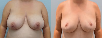Breast Reduction Before & After Gallery - Patient 146106429 - Image 1