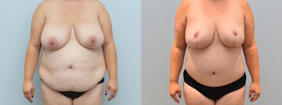 Mommy Makeover Before & After Gallery - Patient 146106433 - Image 1