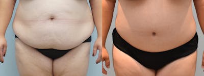 Tummy Tuck Before & After Gallery - Patient 146106435 - Image 1