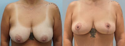 Breast Lift Before & After Gallery - Patient 146106484 - Image 1