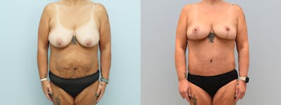 Mommy Makeover Before & After Gallery - Patient 146106486 - Image 1