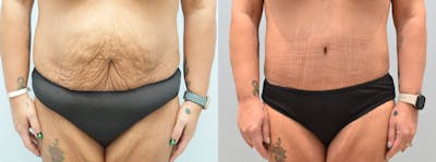 Tummy Tuck Before & After Gallery - Patient 146106487 - Image 1