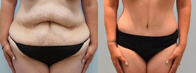 Body Lift Before & After Gallery - Patient 146106543 - Image 1