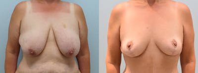 Breast Lift Before & After Gallery - Patient 146106517 - Image 1