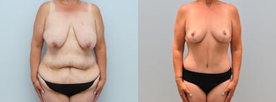 Mommy Makeover Before & After Gallery - Patient 146106546 - Image 1