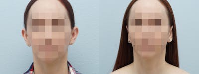 Otoplasty Before & After Gallery - Patient 121338223 - Image 1