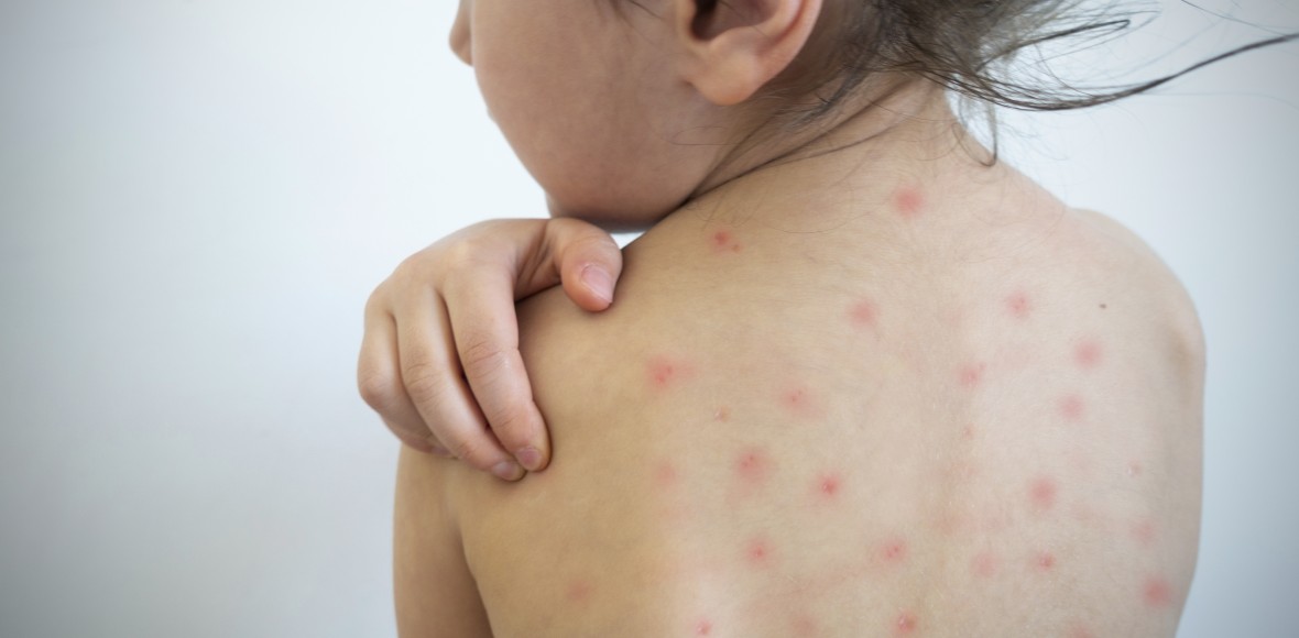highly contagious measles infects a child