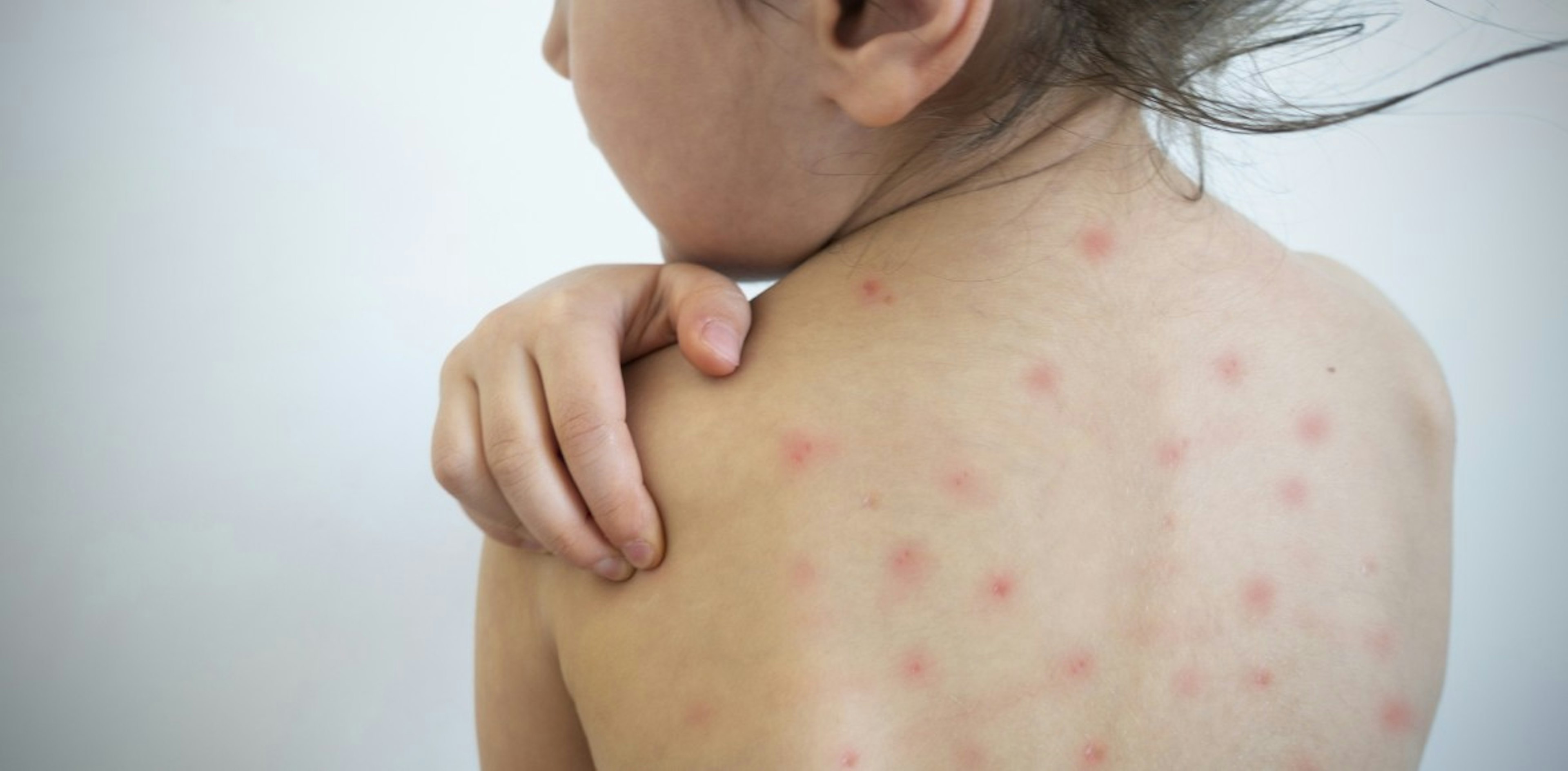 highly contagious measles infects a child