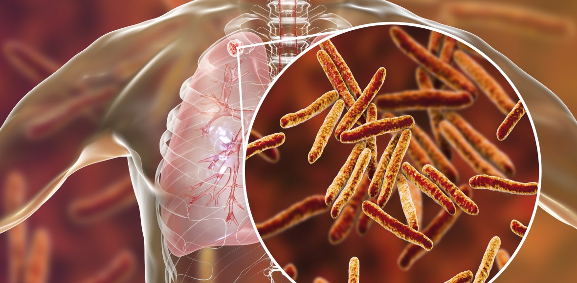 Mycobacterium tuberculosis