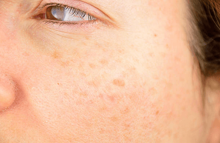 close up of a patients freckles