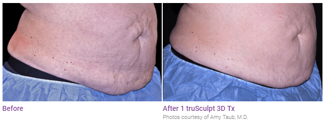 Male patient abdomen before and after