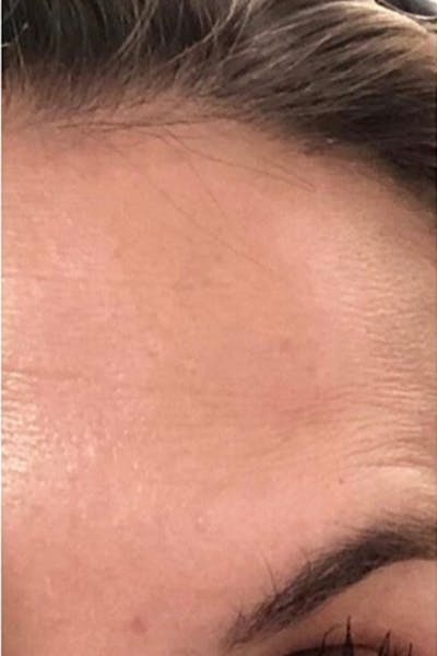 Botox Before & After Gallery - Patient 46619649 - Image 2