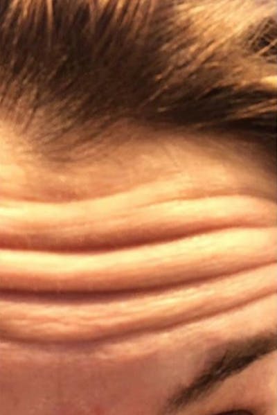 Botox Before & After Gallery - Patient 46619649 - Image 1