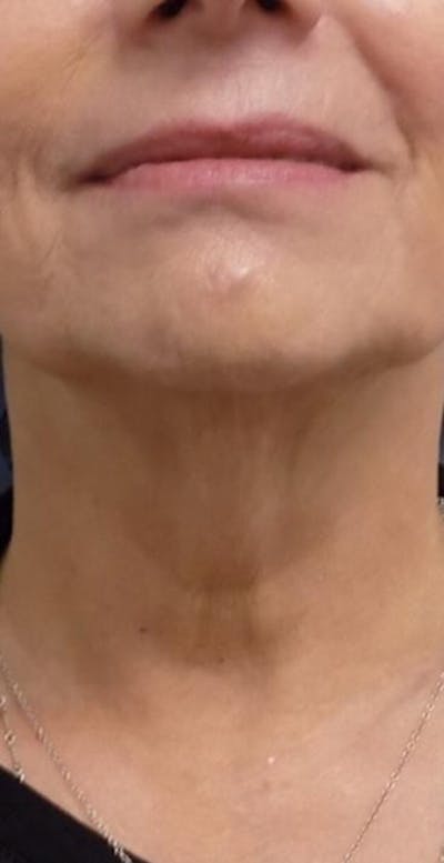 Kybella Before & After Gallery - Patient 46619785 - Image 2