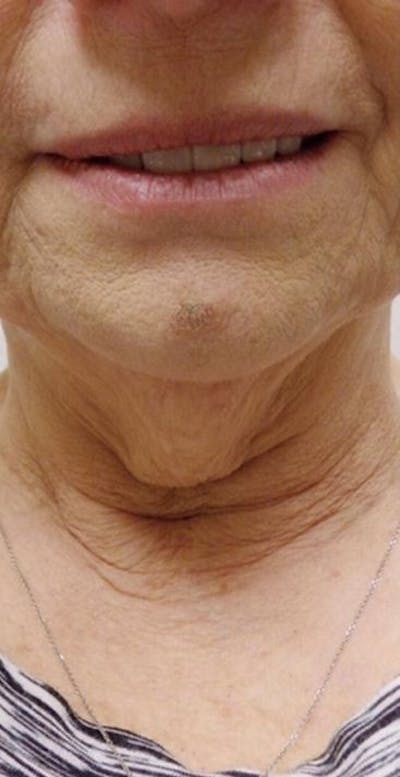 Kybella Before & After Gallery - Patient 46619785 - Image 1