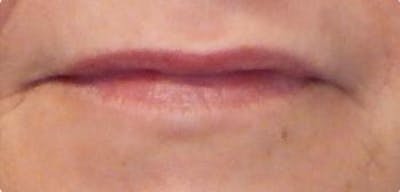 Lip Filler Before & After Gallery - Patient 46620250 - Image 1