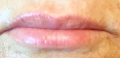 Lip Filler Before & After Gallery - Patient 46620336 - Image 1