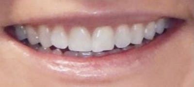 Lip Filler Before & After Gallery - Patient 46620389 - Image 1