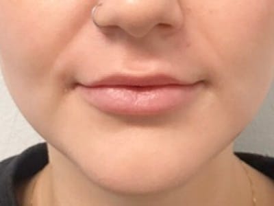 Lip Filler Before & After Gallery - Patient 46620452 - Image 1