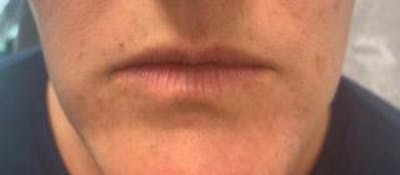 Lip Filler Before & After Gallery - Patient 46620491 - Image 1