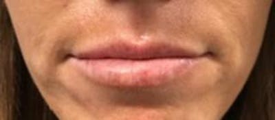 Lip Filler Before & After Gallery - Patient 46620571 - Image 1