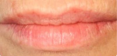 Lip Filler Before & After Gallery - Patient 46620613 - Image 1