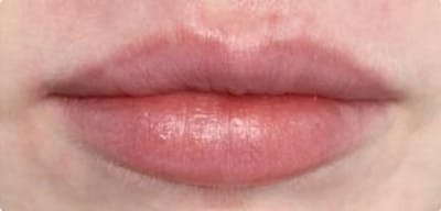 Lip Filler Before & After Gallery - Patient 46620823 - Image 1