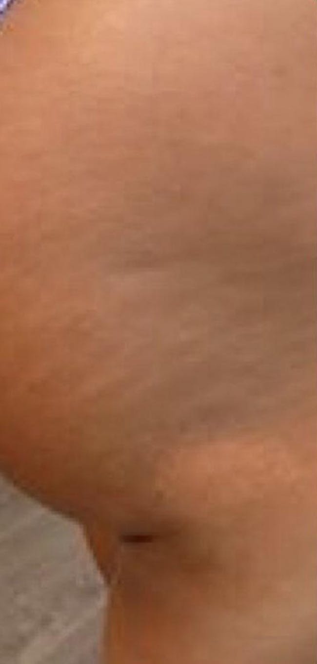 Butt Augmentation