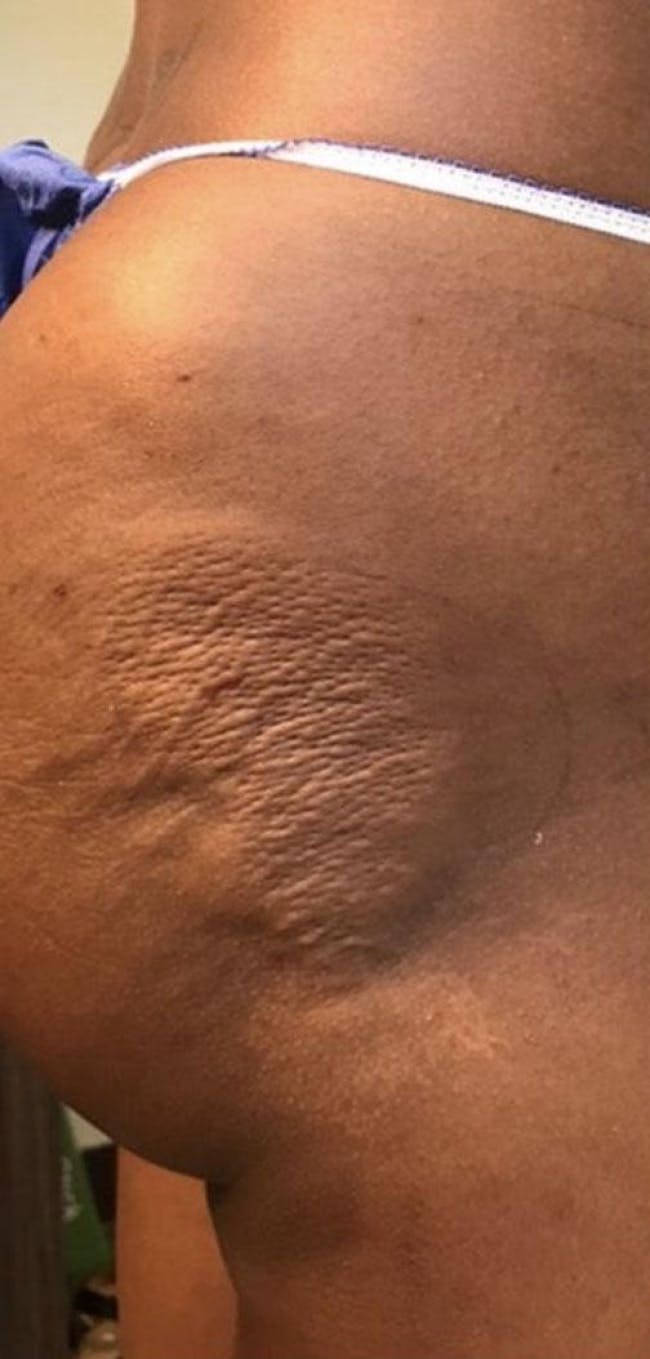 Butt Augmentation