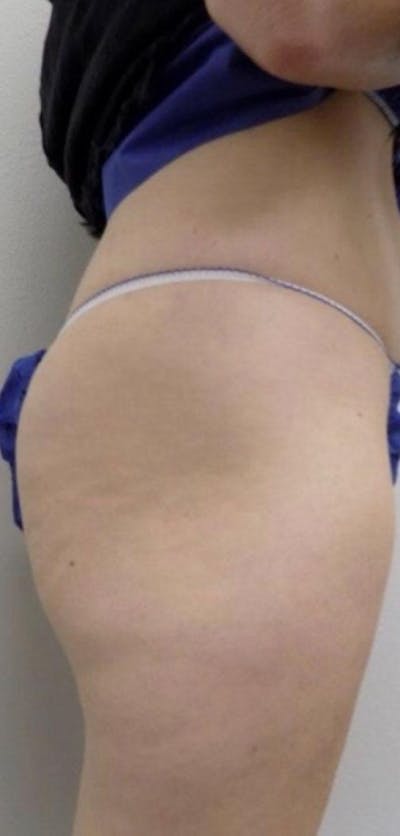 Liquid Butt Lift  Before & After Gallery - Patient 46621334 - Image 1